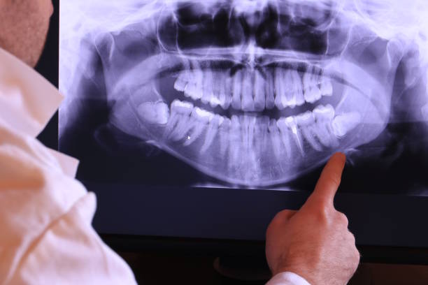 Best Knocked-Out Tooth (Avulsed Tooth) Treatment in Newport, VT